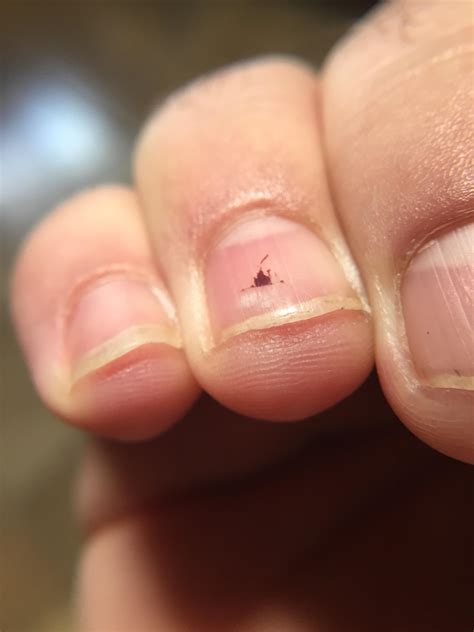 My blood blister under my fingernail looks like Disneyland's Castle. : r/mildlyinteresting