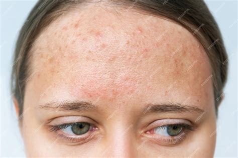 Rash On Forehead