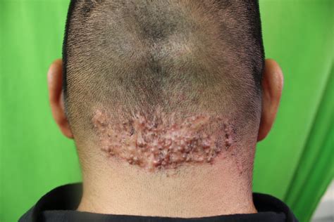 Back Of Neck Acne Treatment at Jennifer Varner blog