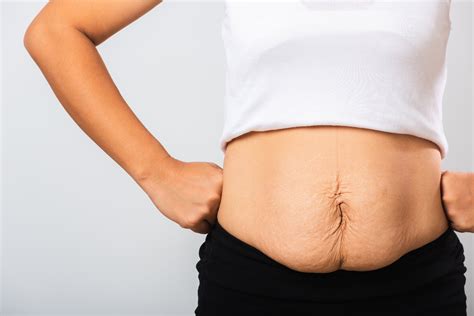 Tips to Prevent Loose Skin After Weight Loss Surgery | NYMIS