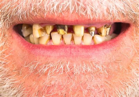 What Causes Meth Face? What Meth Face Look Like?