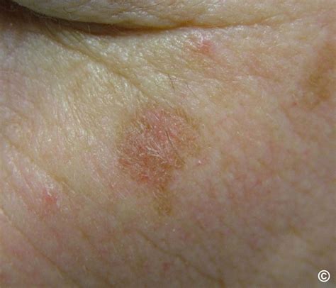 Actinic keratosis, solar keratosis
