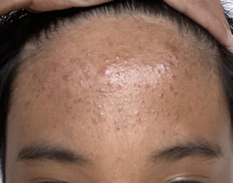 i have a lot of pimples on my forehead, its been here for a long time now, how can i fix this ...