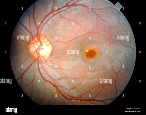 Solar retinopathy. Ophthalmoscope view of the damaged retina of a patient caused by overexposure ...