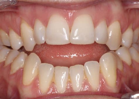 Orthodontic treatment before and after Open Bite - Orthodontix