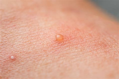 Warts & Molluscum Treatment in Upland & Chino, CA | Skin Physicians ...