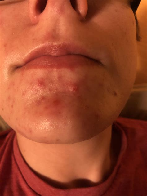 Cystic Pimple On Chin