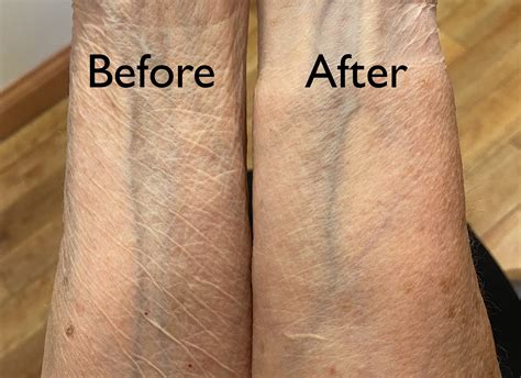 Crepey Skin? You’re not alone.