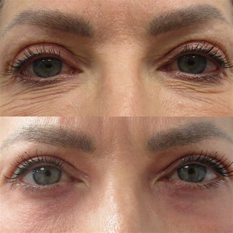 CO2 Laser for Under-Eyes - Newport Beach, Irvine, Costa Mesa, Santa Ana ...