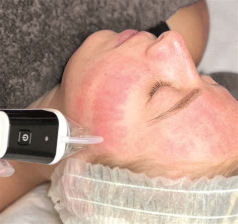 RadioFrequency RF Microneedling at Cheshire Lasers