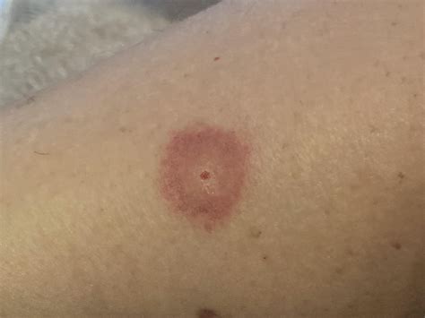 What kind of bug bite? : r/Outdoors