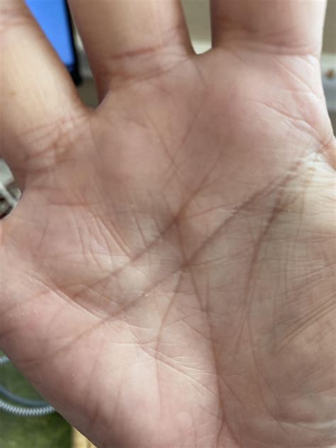 Lump in palm of right hand ? : r/DupuytrenDisease