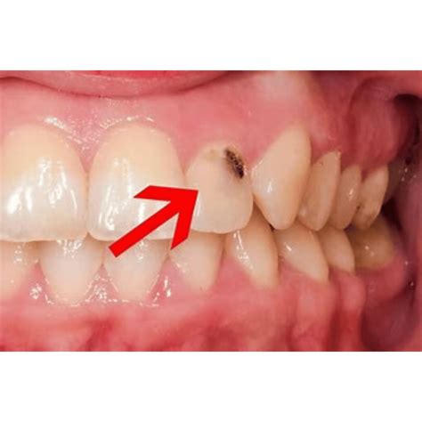 Cavity on Side of Tooth: What It Means and How to Treat It - Smile Studio Boston