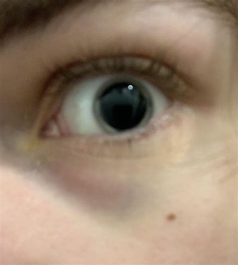 My eye from my appointment with those weird dilating eye drops : r/eyes