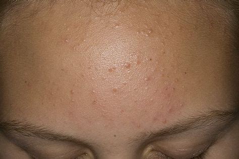 подкожные прыщи, лечение и причины появления, фото акне | Ageless ...