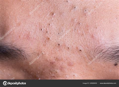 Blackheads On Forehead