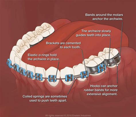 What Is The Definition Of Brace at Harrison Trethowan blog