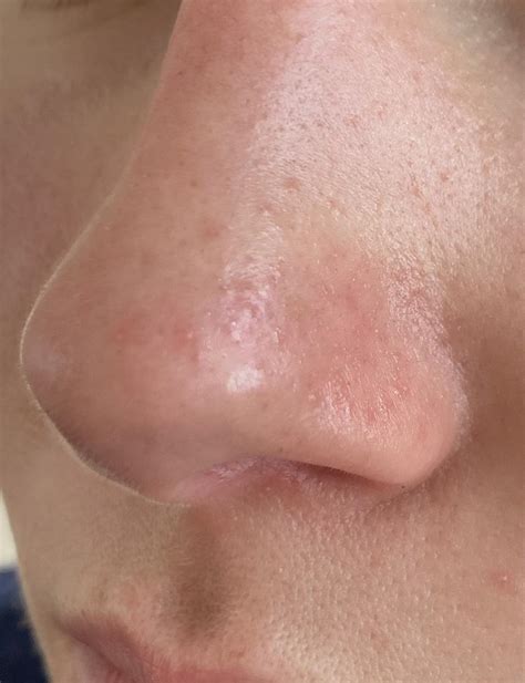 Clogged Pore On Nose