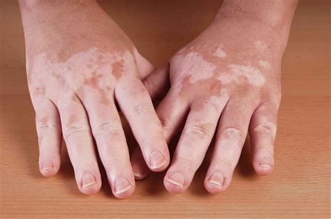 Vitiligo: Types, Causes, and Treatment