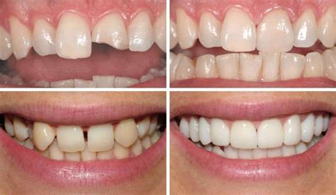 Художня реставрація зубів: що таке, переваги та методи « Dental Guru