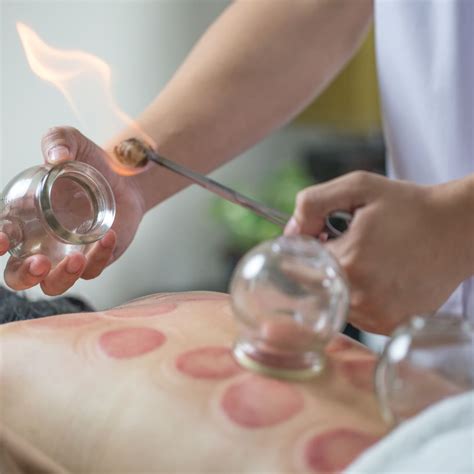 Does Fire Cupping Hurt