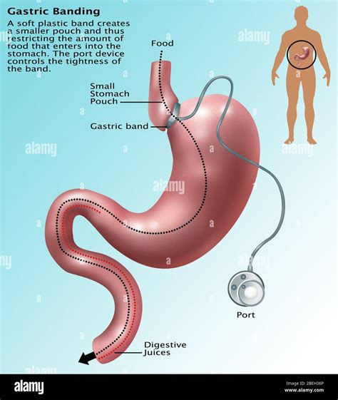 Laparoscopic gastric banding hi-res stock photography and images - Alamy