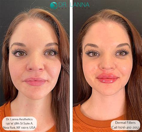 Hyaluronic Acid Dermal Filler Nasolabial at Denise Callaghan blog