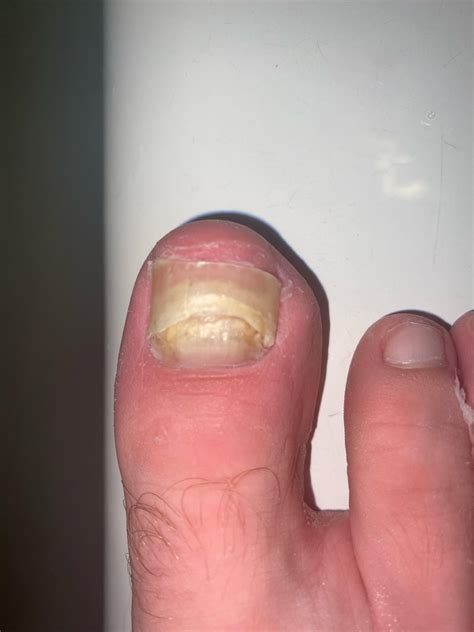 What is this? I went to the doctors a month ago assuming it was a toenail fungus but they weren ...