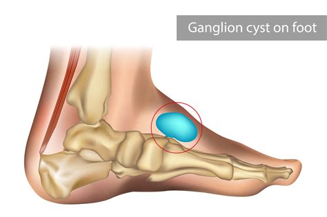 Ganglion Cyst Aspiration