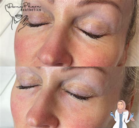 Lumi eyes and S-DNA under eye skin boosters - DermaPharm Aesthetics