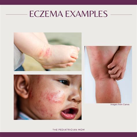 Eczema For Toddlers at Evelyn Lawson blog