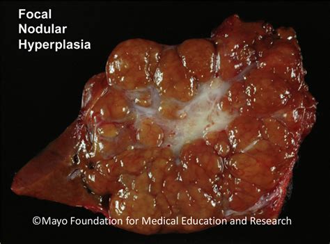 Hepatic Focal Nodular Hyperplasia - Mayo Clinic Proceedings