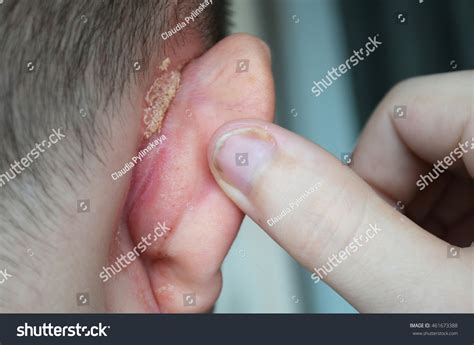 Psoriasis Behind Ear Psoriasis On Nails Foto de stock 461673388 | Shutterstock