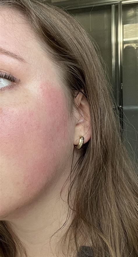 Cold Urticaria Foundation