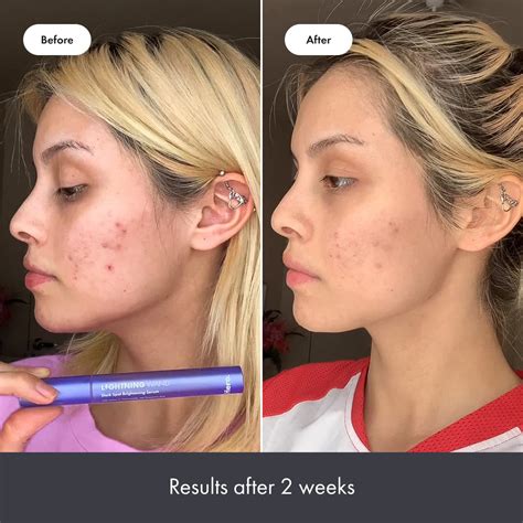 Varita Lightning de Hero Cosmetics – Suero iluminador para manchas oscuras después de manchas ...