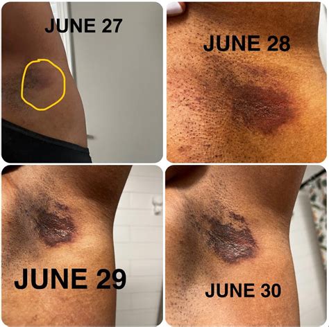 Painful rash in armpit - Any ideas on what it may be? : r/DermatologyQuestions
