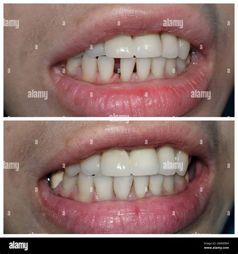 Gap Between Teeth