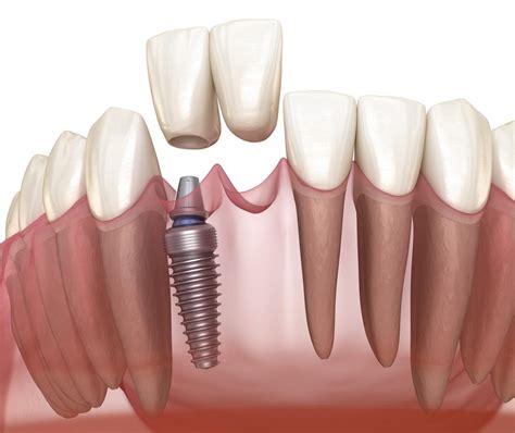 Front Teeth Dental Implants: What to Know