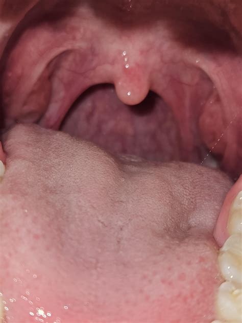 What could this be - sore throat / bumps on tongue? : r/medical_advice
