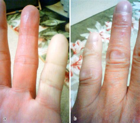 Vascular Complication after Collagenase Injection and Manipulation for Dupuytren’s Contracture ...