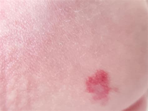 Red spots on newborn : r/DermatologyQuestions