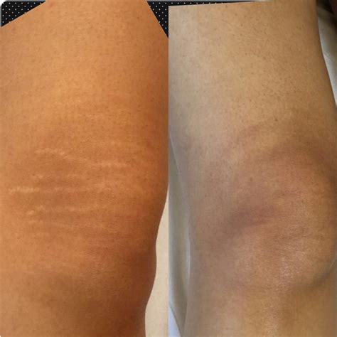 Stretch Marks Removal Treatment Clinic- London - DermaEraze