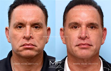 Nasolabial Fold Treatment With Filler & BOTOX® in the San Francisco Bay Area – Mabrie Facial ...