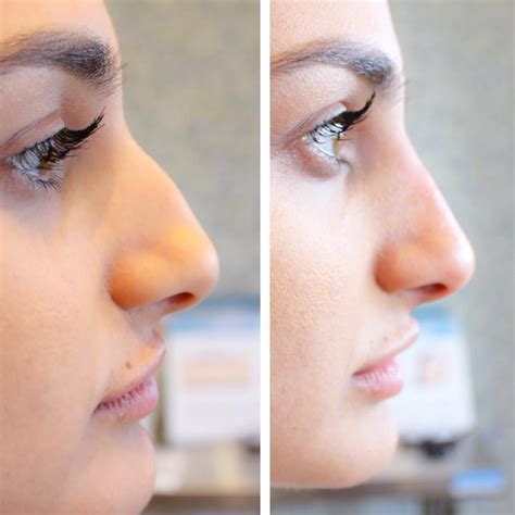 Non Surgical Nose Job Fresno Ca - JOBSTB