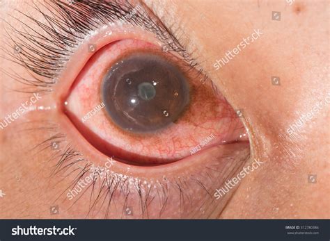 Close Anterior Uveitis Posterior Synechia During Foto stock 312780386 | Shutterstock