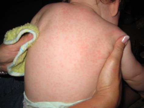 Amoxicillin Rash Baby