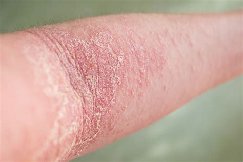 How Long Does Eczema Last?