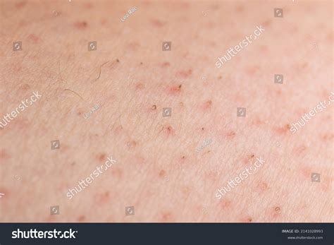 1,002 imágenes de Pimples on the legs - Imágenes, fotos y vectores de ...