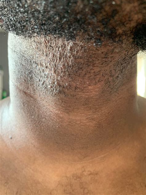 Black Male Ingrown Facial Hair at Hamish Geake blog