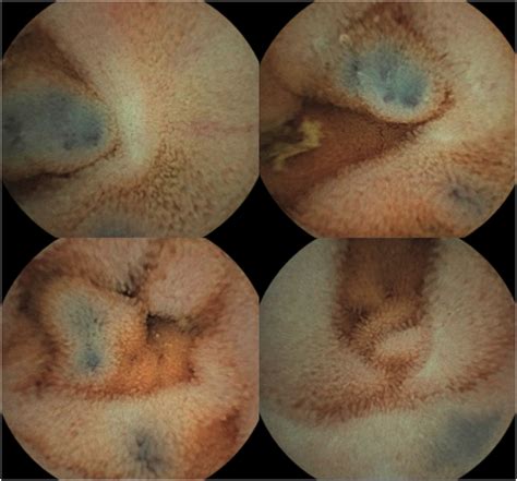 Gastrointestinal: Small intestinal blue rubber bleb nevus syndrome ...